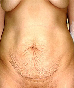 abdominoplastia liposuccion