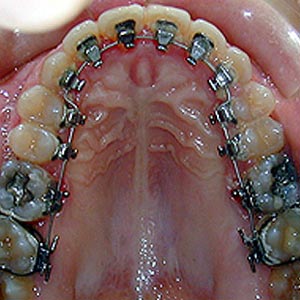 brackets