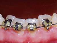braquets Odontologia brackets